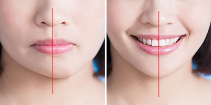 Magic Touch Orthodontist | Protrusion  Buck Teeth , Bad Bites and Facial Imbalance