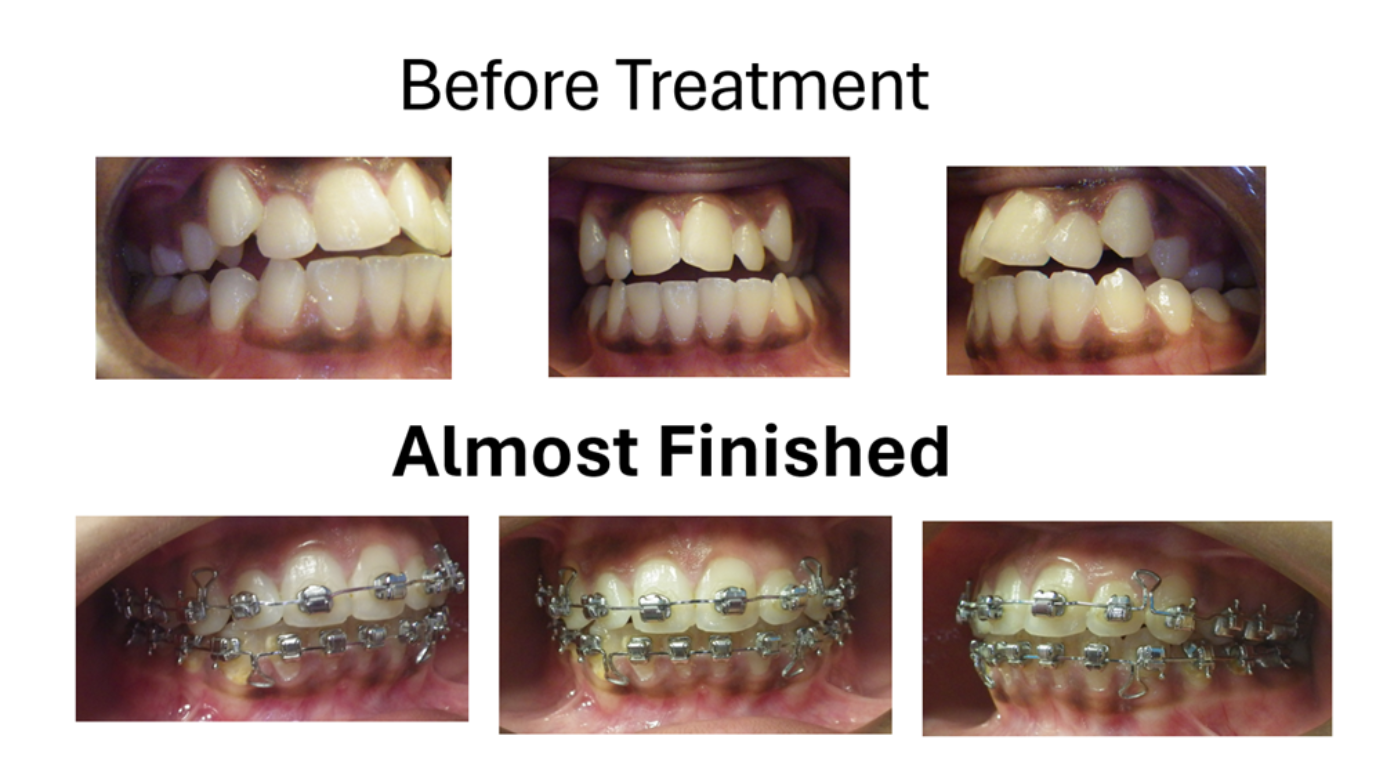 Magic Touch Orthodontist | Early or Late Loss of Baby Teeth, Facial Imbalance and Tongue Thrusting