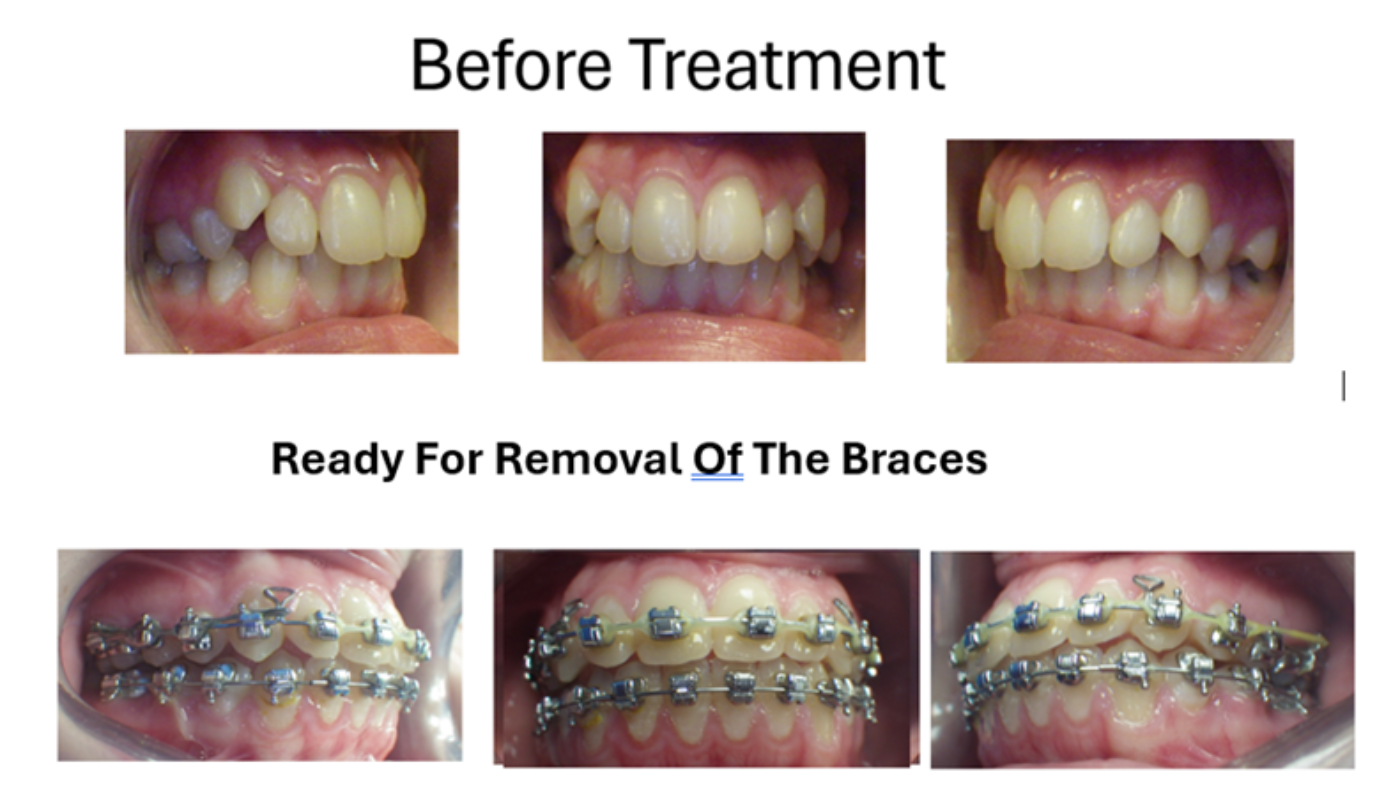 Magic Touch Orthodontist | Deep Bites, Open Bites and Finger Habits