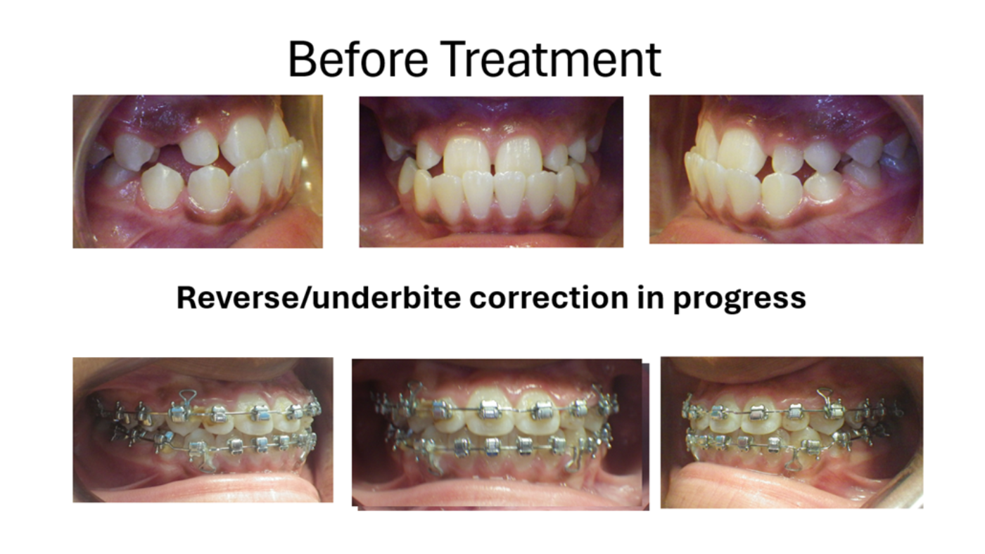 Magic Touch Orthodontist | TMJ Migraine Headaches MPD, Crowding and Sports Mouthguards