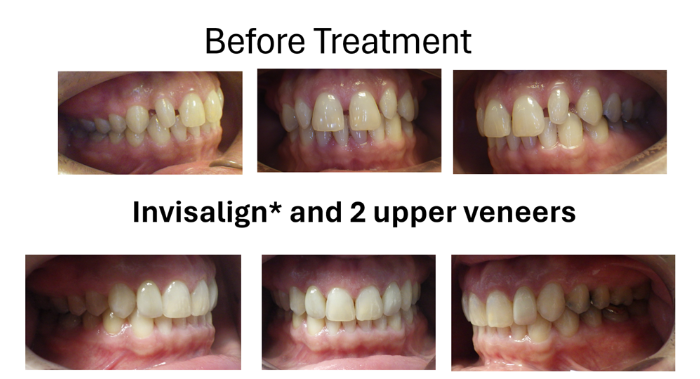 Magic Touch Orthodontist | Cheek Biting, Facial Imbalance and Sports Mouthguards