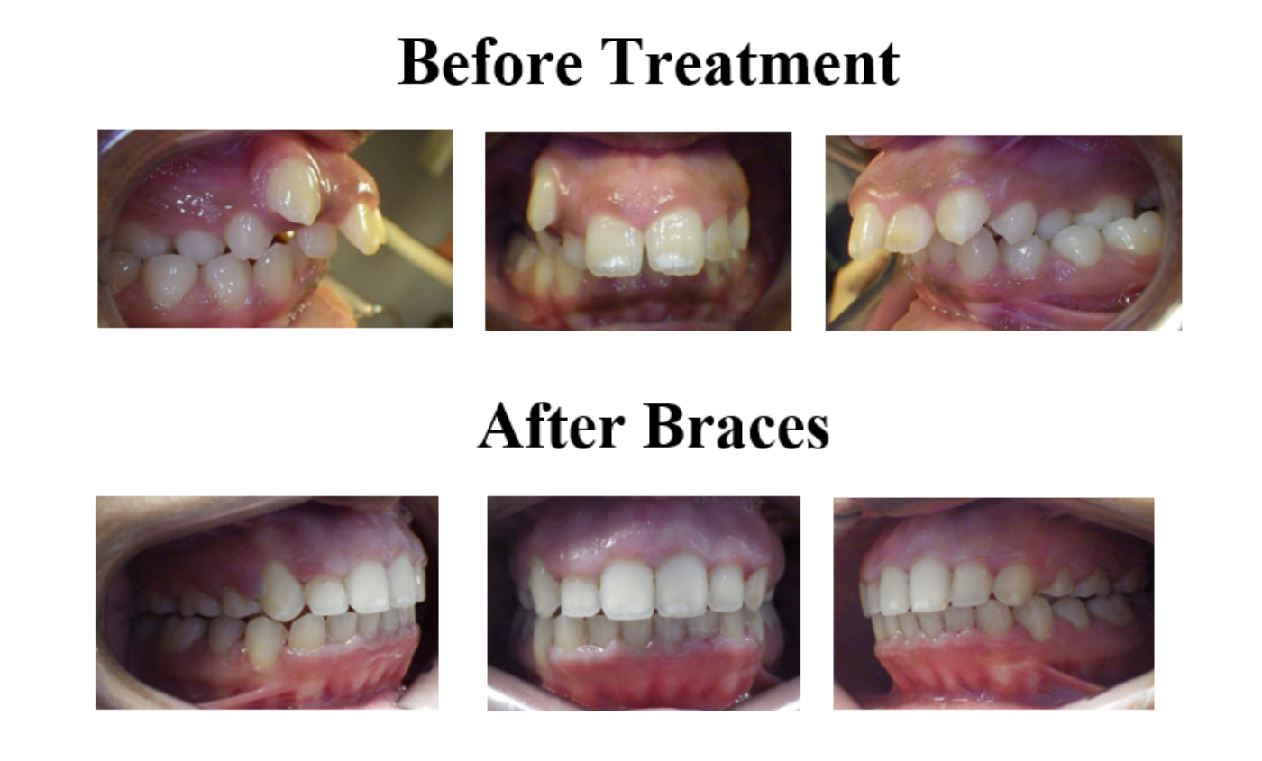 Magic Touch Orthodontist | TMJ/Migraine Headaches/MPD, Night Guards and Protrusion (Buck Teeth)