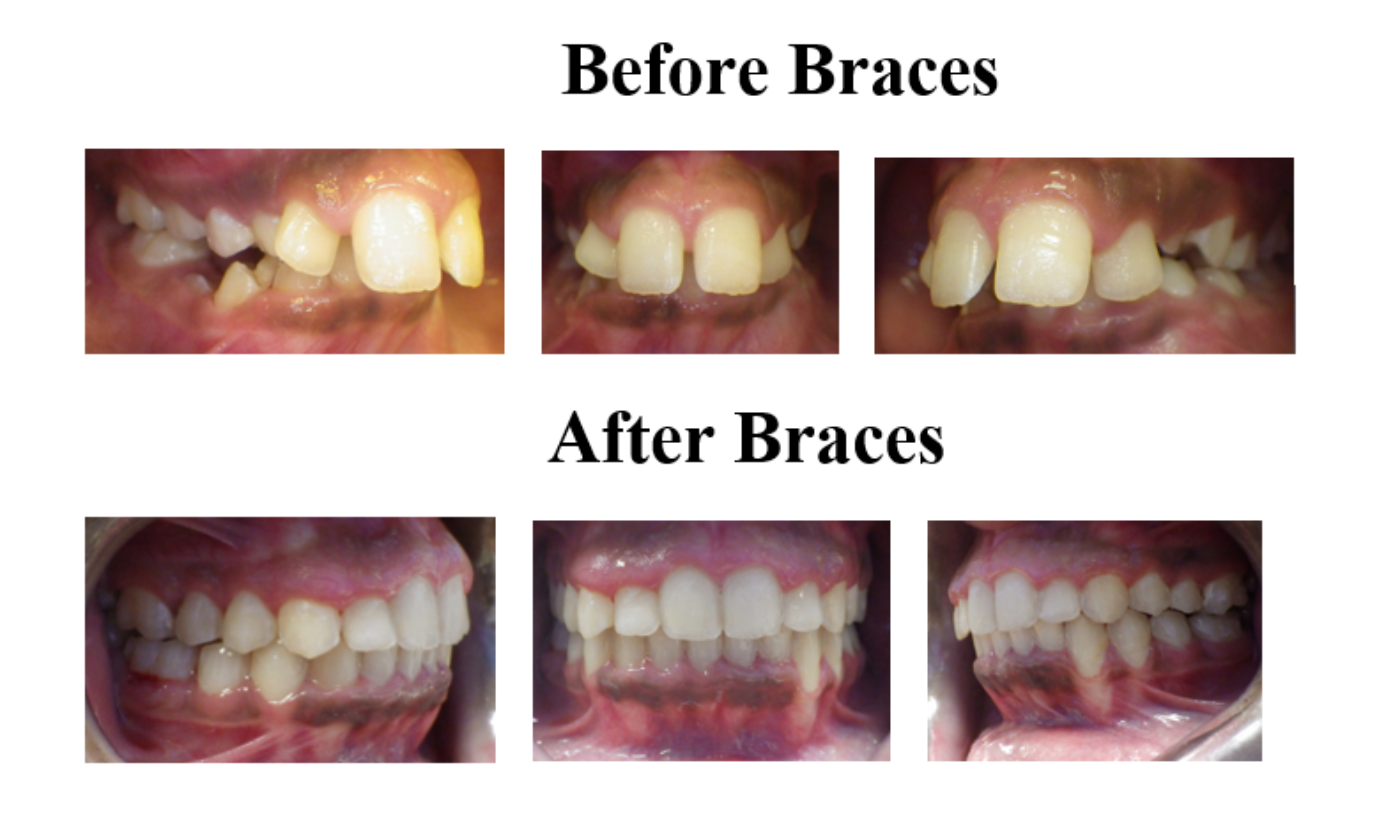 Magic Touch Orthodontist | Orthodontics for Teens, Crowding and Retainers