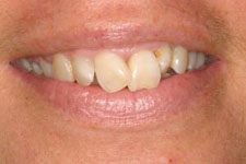 Magic Touch Orthodontist | Cheek Biting, Reverse Underbites and Traditional Metal Braces