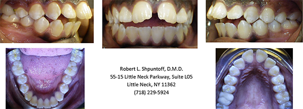 Magic Touch Orthodontist | Early or Late Loss of br  Baby Teeth, Protrusion  Buck Teeth  and Damon Braces
