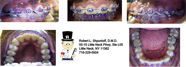 Magic Touch Orthodontist | Protrusion  Buck Teeth , Excessive Spacing and Invisalign reg 